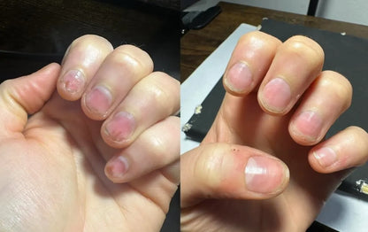 Nailix™ Nagelwachstums-Stift mit Stammzellen